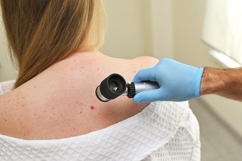 Il caso Livorno riaccende l’allarme melanoma: tra le cause, anche smog e Pfas