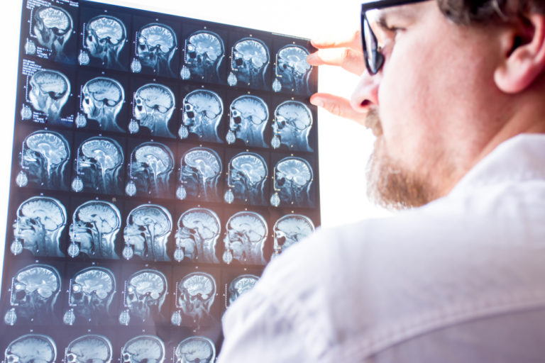 Giornata Mondiale dell’Epilessia, LICE: prioritaria la ricerca per curare tutte le epilessie