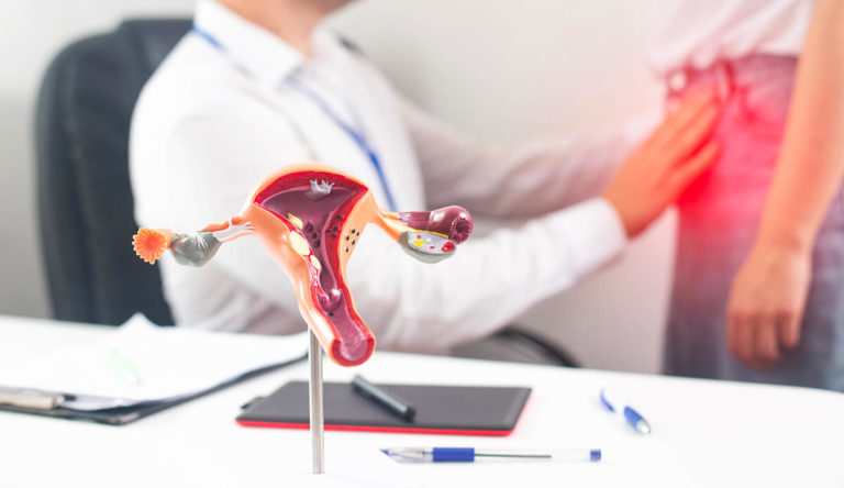 Endometriosi: il nuovo corso Consulcesi sull’importanza di prevenzione e diagnosi precoce