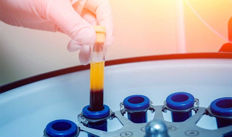 Medicina rigenerativa in ortopedia: PRP anche per l’artrosi