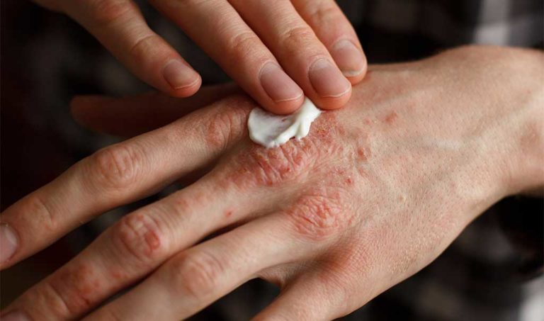 Psoriasi: ancora troppo il peso su salute mentale e qualità della vita